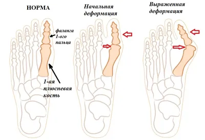 Болит косточка на ноге сбоку: причины, способы лечения | медицинские товары  и медтехника в магазине Ортосалон