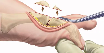 Воспалилась и болит косточка на ноге у большого пальца, что делать? |  медицинские товары и медтехника в магазине Ортосалон