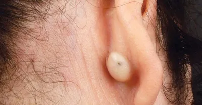 Атерома уха: лечение в МЦ Лазерсвiт