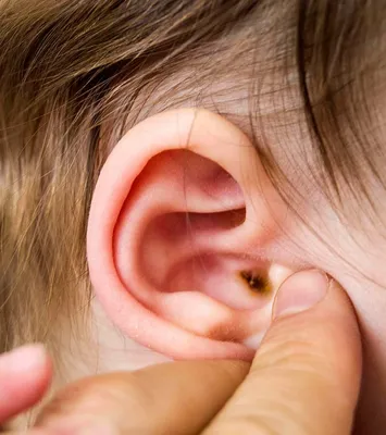 Шишка на хряще уха, воспаление после пирсинга — лечение