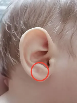 шишка на мочке уха как выглядит｜TikTok Search