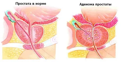 Папилломы на гениталиях - как вести половую жизнь с ВПЧ? | Лазерсвiт в  Одессе