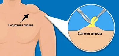 Удаление атеромы - «Бегом к хирургу как только вы заметили у себя на теле  подобную х**** Мой опыт удаления 2 раза! Фото не для впечатлительных! » |  отзывы