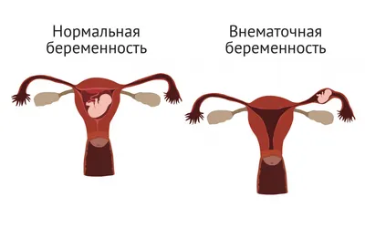 Рак лимфоузлов: Первые симптомы и прогноз с метастазами