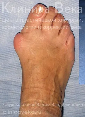 Hallux valgus или паршивые шишки на ногах. История оперативного лечения и  что получилось в итоге | Пикабу