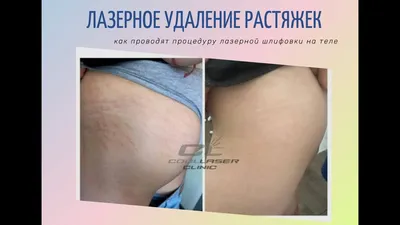 Лазерное удаление растяжек в Минске