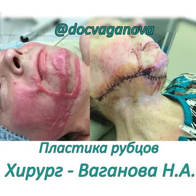 Лечение рубцов после ожогов и травм: пластика, фото до и после |  Интернет-журнал Estetmedicina.ru