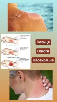 ТОП-3 ОПАСНОСТИ НА ПРИРОДЕ: ОЖОГИ, СОЛНЦЕ, НАСЕКОМЫЕ — Siberian Wellness на  TenChat.ru