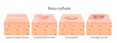 🥇 Удаление шрамов и рубцов лазером в Алматы: Цена, Отзывы. Лазерная  коррекция шрамов на лице