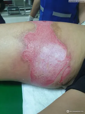 Лечение шрамов и рубцов после ожогов - Блог проекта OMORFIA