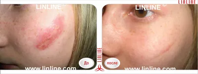 Лазерное удаление шрамов на лице в Киеве, шлифовка Coolaser Clinic