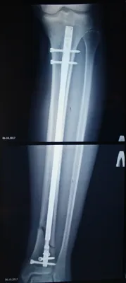 Перелом большеберцовой кости или как я ногу сломал. Часть 2. Операция. |  Пикабу