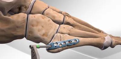 Остеосинтез - «Остеосинтез большеберцовой кости - достижение современной  медицины. Все о новых травматологических центрах, о том как проходит  операция и восстановление после перелома ноги. Фото швов после перелома.» |  отзывы