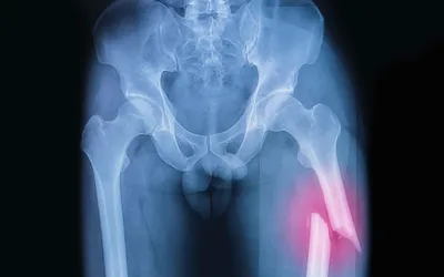 Портативный ортопедический сустав для лодыжки, поддержка хода, коррекция  вальгусной деформации вариуса, Легкая фиксация голеностопа, поддержка шин |  AliExpress