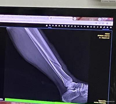 Грузовик раздробил ногу женщине в Алматы