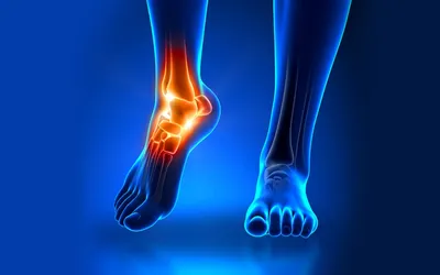 Протез ноги ниже колена - Luxmed Protez