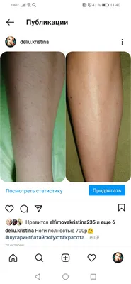 Лазерная эпиляция ног полностью для женщин в Москве: цены | Клиника Медиал