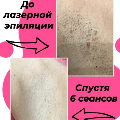 Шугаринг ноги (до/после колена) | Екатеринбург
