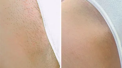 Лазерная эпиляция ног - Удаление волос на ногах лазером