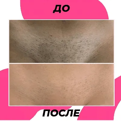 Уход за кожей до и после депиляции | imkosmetik журнал о маникюре и красоте