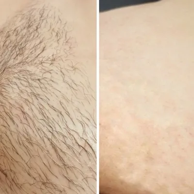 Лазерная эпиляция волос на теле в Самаре | Цены на удаление волос в центре  косметологии – Клиника «Доктор Борменталь»