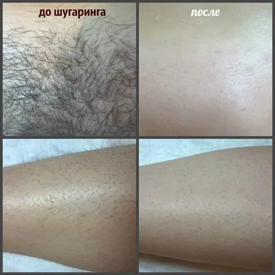 Лазерная эпиляция глубокого бикини: фото до и после, идеальная гладкость  кожи от LaserVille