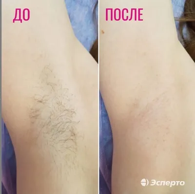 Лазерная эпиляция лица - клиника лазерной косметологии в Санкт-Петербурге