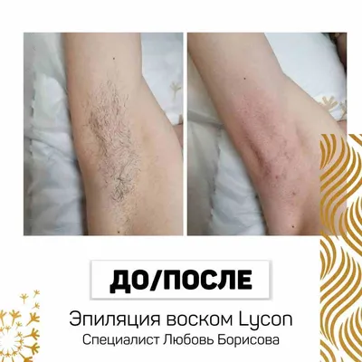 Косметолог Эстетист Бишкек - Шугаринг подмышек в первый раз сделали 3  недели назад. После бритвы. ⠀ Посмотрите какие волосы выросли после  депиляции 👍 Мягкие, тонкие. ⠀ А подмышки без волос ✌красиво и