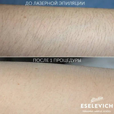 Лазерная эпиляция для мужчин в Москве: цены в зависимости от зоны, отзывы,  фото до и после процедуры