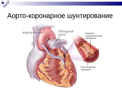 Коронарное шунтирование через малый доступ бесплатно по полису ОМС