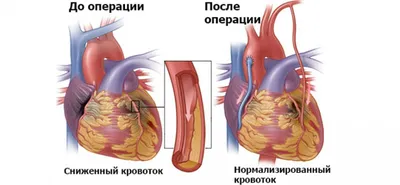 Операция шунтирование сердца – цена в ФНКЦ ФМБА России