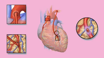 Стенокардия. Причины, диагностика и лечение. - Новости Клиники Сердца