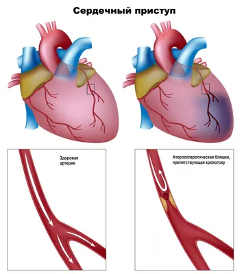 Стоимость шунтирования сердца за рубежом | MedicGlobus