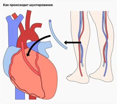 Стеноз сосудов - лечение, симптомы заболевания, причины появления,  диагностика