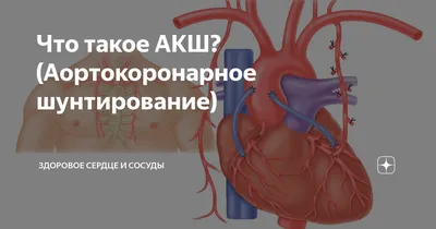 American Hospital - 🩺 SHUNTLASH: BU NIMA VA UNING FOYDASI NIMADA? Koronar  shuntlash — bu shikastlangan tomir shunt bilan almashtiriladigan operatsiya  bo'lib, unda shunt sifatida bemorning tomirlari va arteriyalaridan  foydalaniladi. Transplant orqali