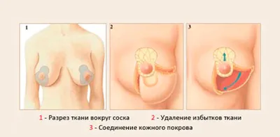 Лабиопластика - цена операции по пластике больших и малых половых губ в  Москве | АльтраВита