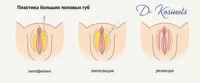 Лабиопластика — Москва