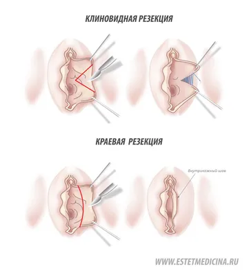 Лабиопластика - «Половые губы как уши спаниеля. Лабиопластика дважды у  одного доктора. Чего надо боятся. Подготовка. Течение. ПОЧЕМУ не стоит  ходить к доктору без портфолио. Виды разрезов, какие бывают НЕУДАЧНЫЕ  операции » | отзывы