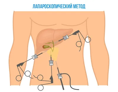 Сколько носить бандаж после удаления желчного пузыря — Статьи — Официальный  сайт Интекс