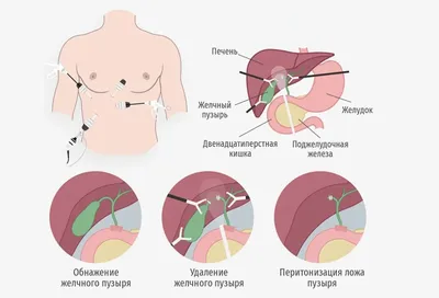 Операция по удалению желчного пузыря входит в пакет ОМС - госагентство  Азербайджана