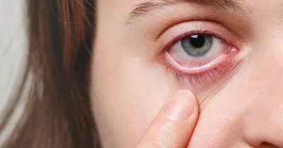 Ячмень на глазу: лечение, причины и симптомы