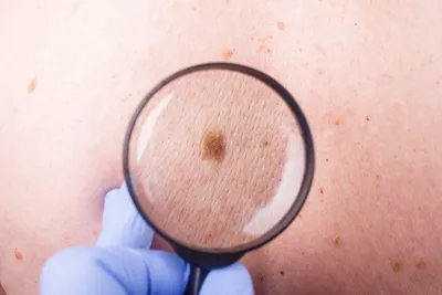 Плоскоклеточный рак кожи - причины появления, симптомы заболевания,  диагностика и способы лечения