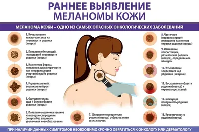 Меланома кожи - симптомы, диагностика и методы лечения | Daily Medical