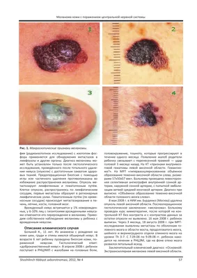 Меланома кожи: стадии, фото и процедура лечения. Онкология