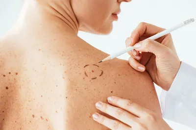 Рак кожи может проявляться скрытыми симптомами - 5 самых распространенных |  Стайлер