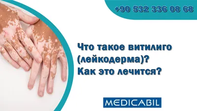 Dr.Sahin Mirzeyev - КАЛЬЦИНОЗ КОЖИ (calcinosis cutis). Синонимы:  метаболический кальциноз, липокальциногранулематоз, болезнь Профише,  липоидокальциноз, синдром Тейчлендера, идиопатический кальциноз и т. д.  Первое описание универсального кальциноза ...