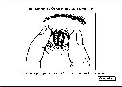 Кейтин Стиклс - модель с синдромом кошачьего глаза, которая покорила