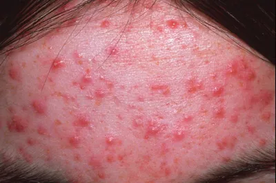Анамнез. Состояние иммунитета У взрослых синдром ошпаренной кожи бывает при  иммунодефиците и почечной недостаточности.