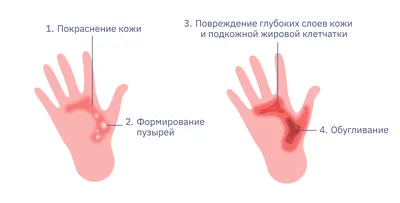 Солнечный ожог: первая помощь и лечение, что делать и чем мазать