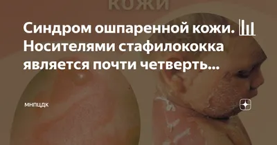 Рассказываем про \"синдром ошпаренной кожи\" - редкое и опасное заболевание |  Современные лечебные повязки | Дзен